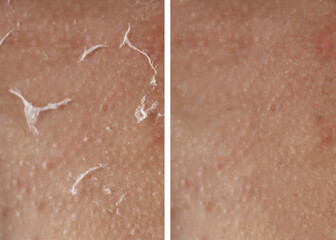 Fototapeta premium Dry skin before and after moisturizing, marco view. Collage for comparison