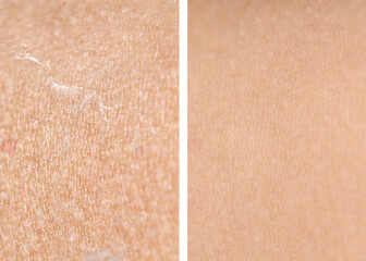 Fototapeta premium Dry skin before and after moisturizing, marco view. Collage for comparison
