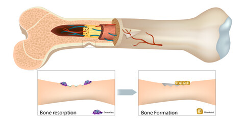 Human Bone Remodeling Illustration with Osteoclasts and Osteoblasts. Long Bone Cross Section Showing Resorption and Formation Stages