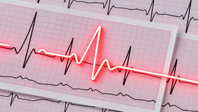 Medical ECG printout with glowing red neon heartbeat line across cardiogram paper, high detail, clear waveform, clinical background