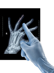 Post operative x-ray distal interphalangeal joint fusion arthrodesis of the proximal ring finger with splint pin wires hand in glove