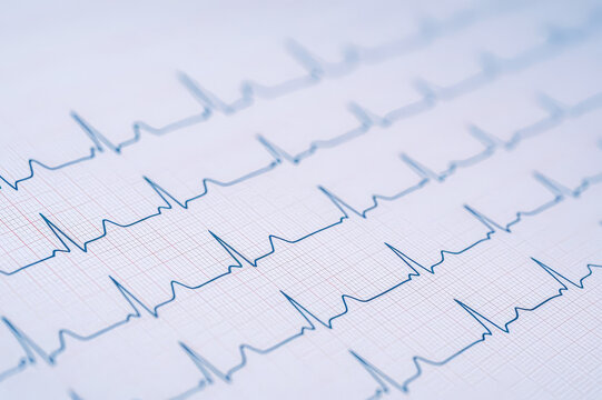 Close-up of black ECG waveform on medical cardiogram paper with pink grid, clear electrocardiogram pattern showing regular heart rhythm trace