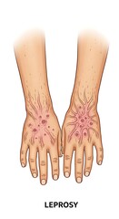 Illustration of Leprosy Skin Lesions on Hands, Medical Condition.