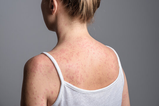 A woman with a red, spotty rash caused by measles.