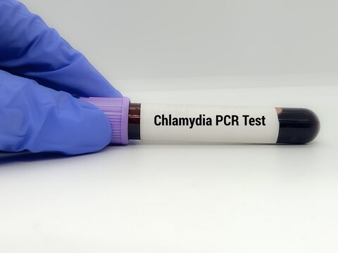 Doctor  holding a test blood sample for Chlamydia PCR - test. Laboratory medical testing concept.