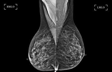  X-ray Digital Mammogram of Both side CC view and MLO view showing multiple cysts and complicated cysts scattered at bilateral breasts. BI-RADS CATEGORY 3: Probably benign.