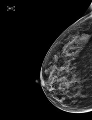  X-ray Digital Mammogram of Both side CC view and MLO view showing multiple cysts and complicated cysts scattered at bilateral breasts. BI-RADS CATEGORY 3: Probably benign.