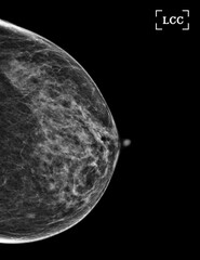  X-ray Digital Mammogram of Both side CC view and MLO view showing multiple cysts and complicated cysts scattered at bilateral breasts. BI-RADS CATEGORY 3: Probably benign.