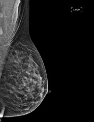  X-ray Digital Mammogram of Both side CC view and MLO view showing multiple cysts and complicated cysts scattered at bilateral breasts. BI-RADS CATEGORY 3: Probably benign.