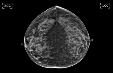 X-ray Digital Mammogram of Both side CC view and MLO view showing multiple cysts and complicated cysts scattered at bilateral breasts. BI-RADS CATEGORY 3: Probably benign.