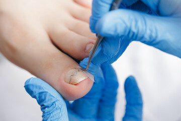 Podiatrist treating ingrown toenail on caucasian adult foot with precision tools
