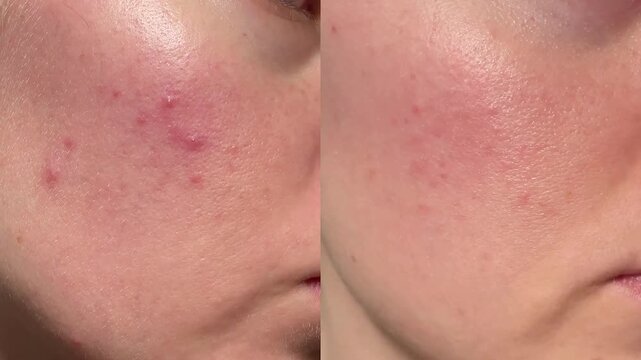 Close-up of irritated cheek skin with redness, acne bumps and uneven texture. Ideal for dermatology, skincare issues, cosmetic treatment guides, medical references and inflammation education.