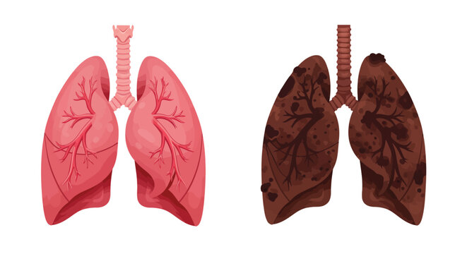 Medical illustration comparing healthy pink lungs and diseased black smoker's lungs