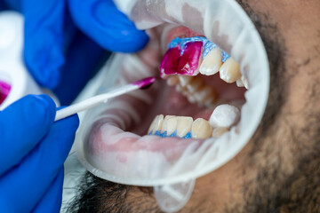 dentist applies whitening gel on the teeth whitening procedure