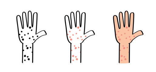 Skin rash, measles on hand. allergy causing itching, skin irritation. Red rash on the body. food allergy orother autoimmune diseases. Rubeola or morbilli symptom. food allergy. Eczema, smallpox.