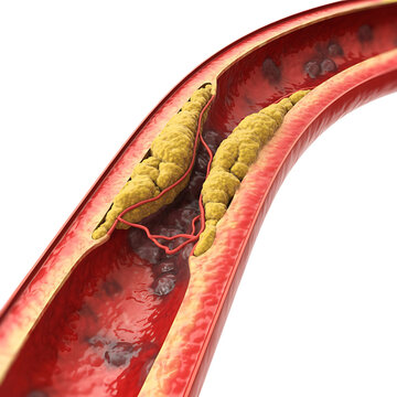 Cholesterol Plaque Buildup Inside Human Artery Showing Atherosclerosis