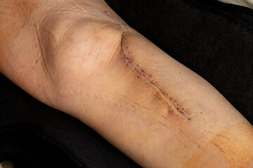 Naklejka premium A close-up shot of a woman's lower leg, featuring a fresh post-operative scar following open reduction and internal fixation of a tibia fracture with a metal plate