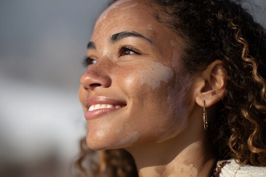 Close-up of a young woman smiling with vitiligo in natural light