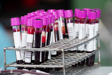 Close up of blood samples in test tubes with purple caps arranged in a metal rack at a laboratory. Medical analysis and health testing concept for diagnosis, research, and clinical examination.