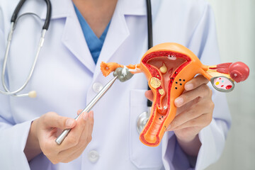 Uterus, doctor holding human anatomy model for study diagnosis and treatment in hospital.
