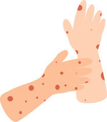 Illustration of human arms with red spots, showing skin rash, allergic reaction, or eczema. Dermatitis medical concept.