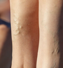 The leg of a person with a visible vein