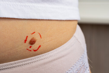 Birthmark and skin health checkup for melanoma prevention