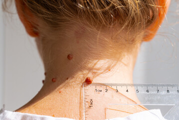 Birthmarks and skin health considerations