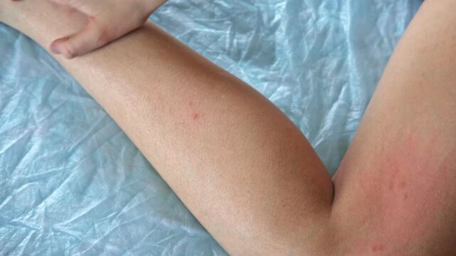 Child scratch body sensitive itchy skin. Bodily rash. Teen allergy closeup. Teenage girl scratches eruption. Irritation, hive. Pruritus. Mosquito flea insect bite. Red sunburn, Seborrheic Dermatitis