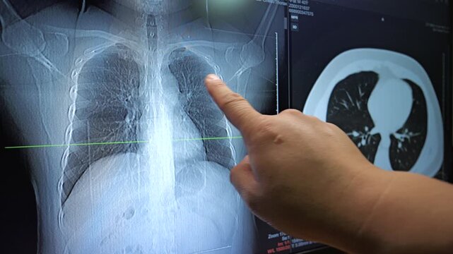 A doctor's hand points directly at a digital chest X-ray and CT scan displayed on a medical monitor.