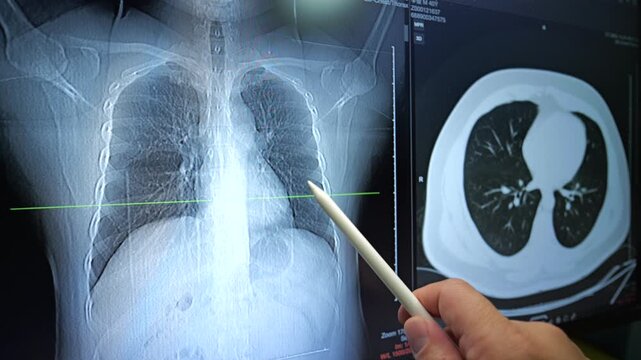 A medical professional uses a stylus to point at a digital chest X-ray and a cross-sectional CT scan on a monitor.