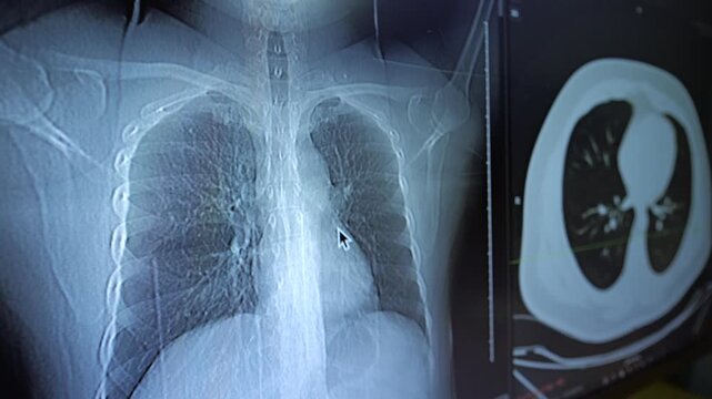 A close-up view of a digital chest X-ray and axial CT scan displayed on a medical workstation screen.