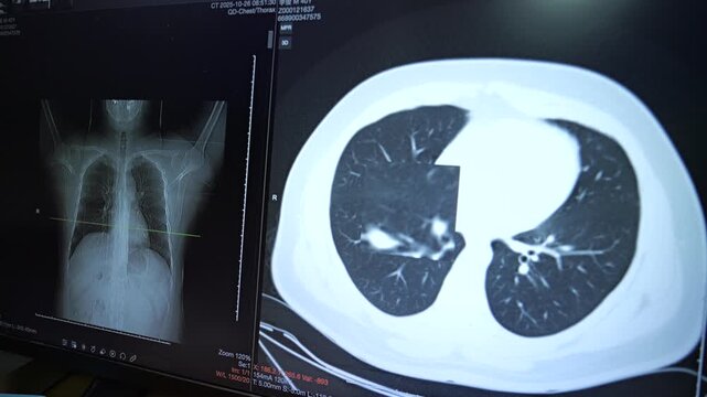A detailed view of a medical monitor displaying chest X-ray and CT scan, suggesting an enlarged inspection of the lung tissue.
