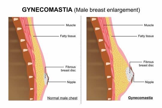 Gynecomastia (male breast enlargement)