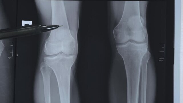X-ray of dysplastic coxarthrosis. Deformation of the left femoral head. Aseptic necrosis and massive cystic changes in the hip joint. Shortening of the left lower limb by 4.0 cm.
