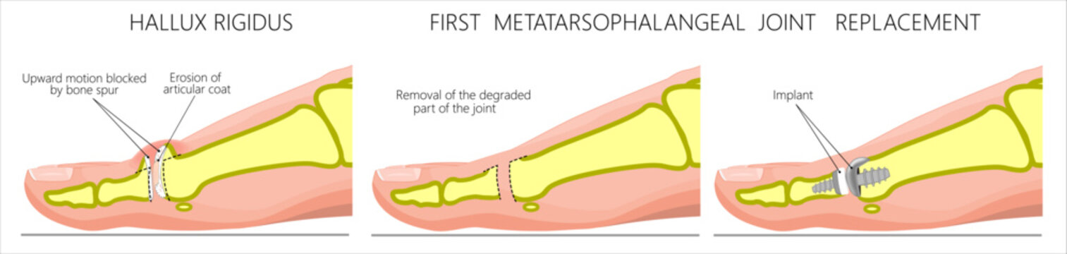 Hallux rigidus traetment. First metatarsophalangeal joint replacement