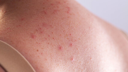 Red pimples and rashes on female skin. Concept of chronic dermatological diseases, allergy to...