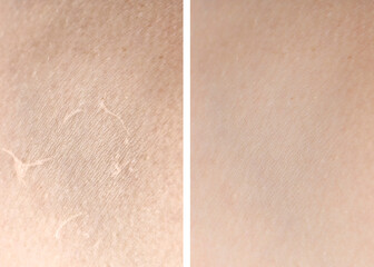 Fototapeta premium Dry skin before and after moisturizing, marco view. Collage for comparison