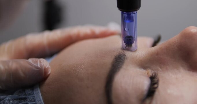 Woman receives cosmetic facial treatments. Microneedling for facial skin. Restoration and rejuvenation of female beauty and health. Beauty business.
