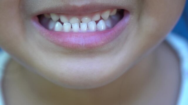 A child smiles showing off his ugly teeth and black teeth.