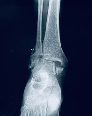 Ankle AP X-Ray Showing Displaced Distal Fibula Fracture and Mortise Disruption