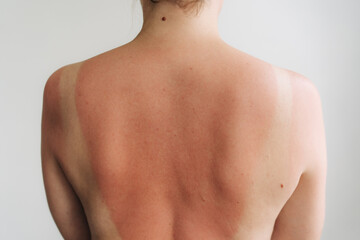 Naklejka premium Back view of sunburned shoulders and reddened upper back after outdoor exposure