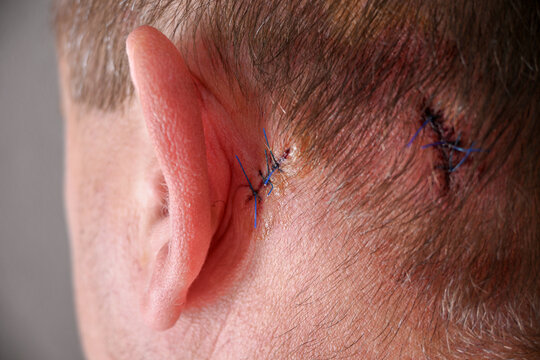 Man's scalp exhibiting surgical sutures closing skin wound from injury