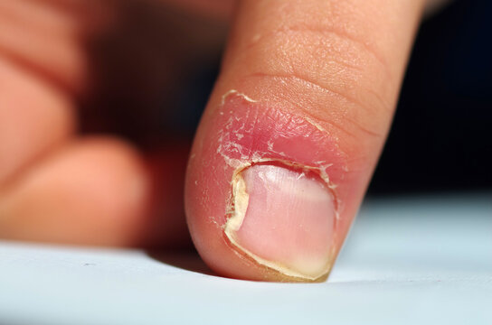 Skin disease. Lichen, psoriasis and skin diseases	