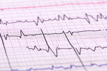 ECG electrocardiogram