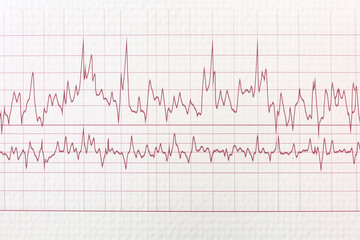 ECG electrocardiogram