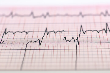 ECG electrocardiogram