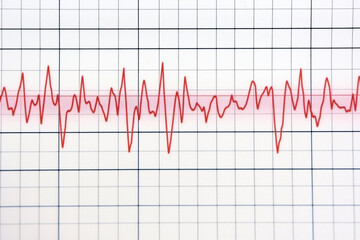 ECG electrocardiogram