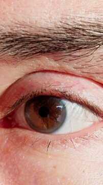 red irritated eye caucasian man showing allergy symptom, close macro of bloodshot sclera and swollen eyelid, clinical examination vibe with subtle tear film, skin pores and brow detail, conveys