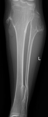 Osteochondroma  and  Multiple Hereditary Exostosis x ray 